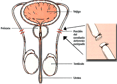 Esterilización masculina. Vasectomía